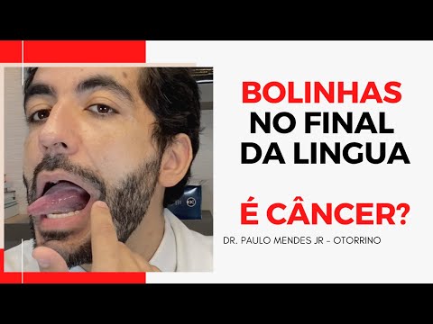 Como examinar a sua língua para ver se bolinhas no fundo da garganta é CÂNCER ?