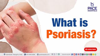 Psoriasis Disease  | What is Psoriasis ?  |  #psoriasis