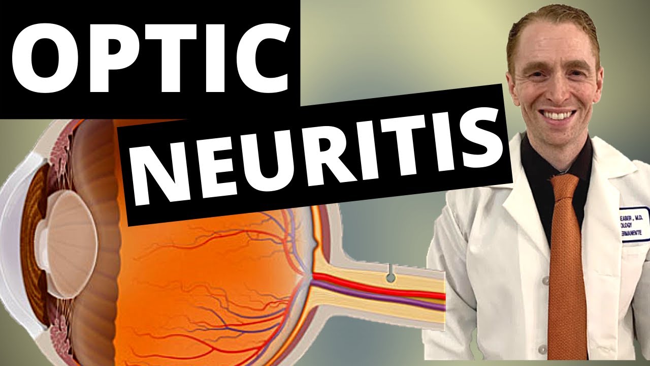 Optic Neuritis Symptoms, Diagnosis, and Treatment - YouTube