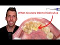 What dental calculus really means on the carnivore diet