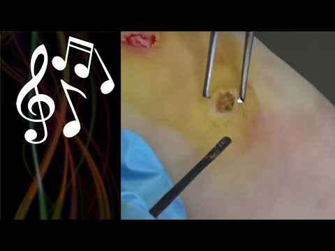 Triple Wart Removal - Warts Be Gone!