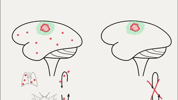 Doctor Explains Brain Metastases versus Brain Tumors