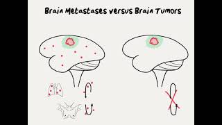 Doctor Explains Brain Metastases versus Brain Tumors