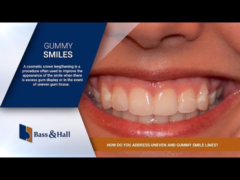 How Do You Address Uneven and Gummy Smile Lines? | Bass &amp; Hall Dental Implant &amp; Periodontal Partners