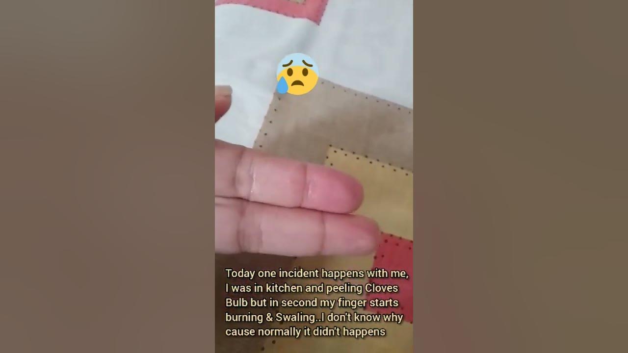 finger burn how to heal garlic burning on finger how to cure hands burning chilli & garlic