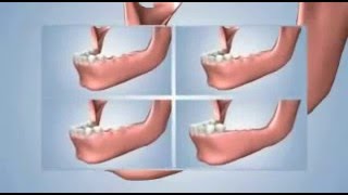 Several missing teeth replacement options