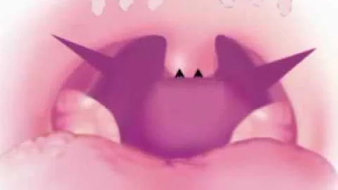 Como é feita a cirurgia para parar de roncar?