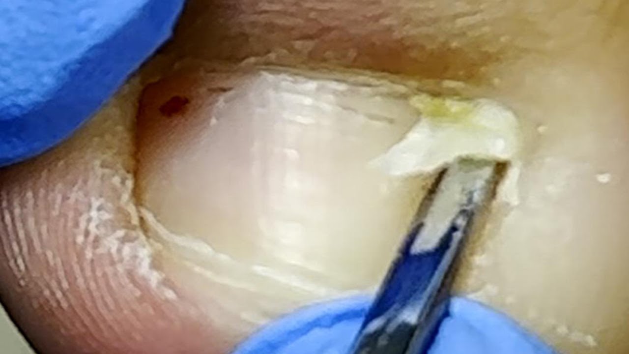 Inflammation of the base of the toenail! dig out huge nails【Xue Yidao Pedicure】 YouTube