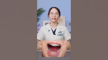 Mắc cài kim loại tự động và mắc cài kim loại buộc chun (P1) | Lạc Việt Intech Niềng Răng #shorts
