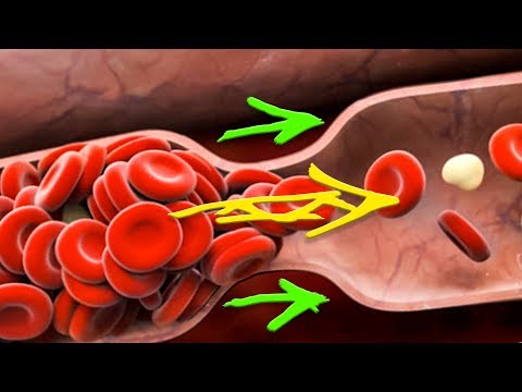 Самое лучшее Разжижение крови без химии! Профилактика атеросклероза и тромбофлебита