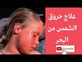 خطوات علاج حروق الشمس من البحر فى الصيف Treatment And Recovery لو رايح المصيف 
