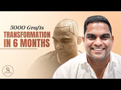 From Baldness to Bold Look 🔥 | 5000 Grafts Hair Transplant Result | Vashi/Navi Mumbai