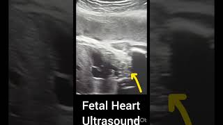 Ultrasound showing Fetal Cardiac Activity!Obstetric Ultrasound!#ultrasoundmadeeasy86#baby#india#usa