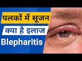 पलकों की सुजान or Blepharitis: Symptoms, causes, and treatment