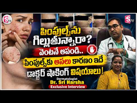 పింపుల్స్ గురించి ఎవరికీ తెలియని నిజాలు! || Dermatologist Dr. Sri Harsha Exclusive Interview
