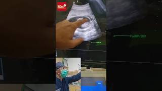 Gambaran Usg Bayi Kembar