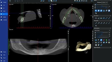 Creating a Pan from CBCT of an Edentulous Patient