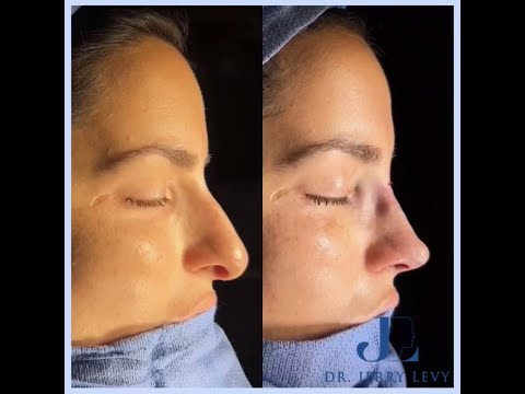 Rhinoplastie de préservation à paris