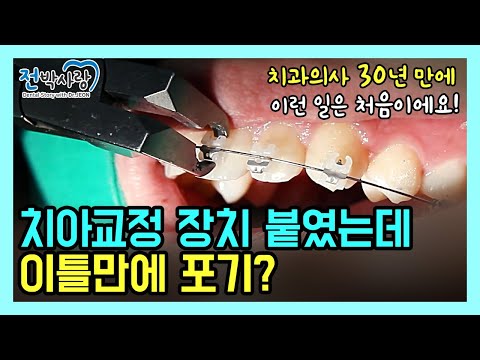 1-60. 치아교정 장치 선택 방법!