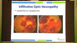 AIOC 2026   IC210   All you want to know about the optic nerve the window to glaucoma and neuro opht