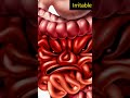 Irritable Bowel Syndrome: The Pain Nobody Talks About