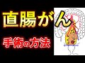 40代～70代必見！低位前方切除術の基礎知識　【医師解説】