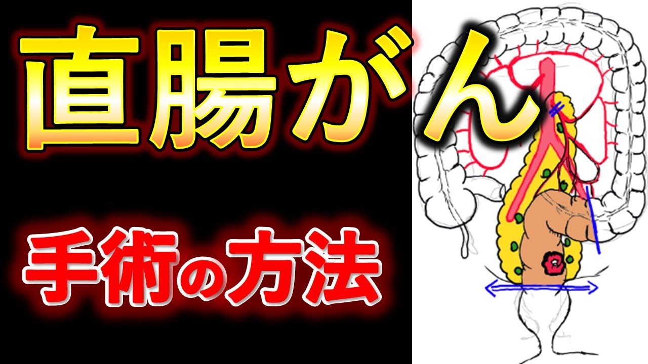 超低位前方切除術術式: 超低位前方切除術 一時的人 – ZUCICY