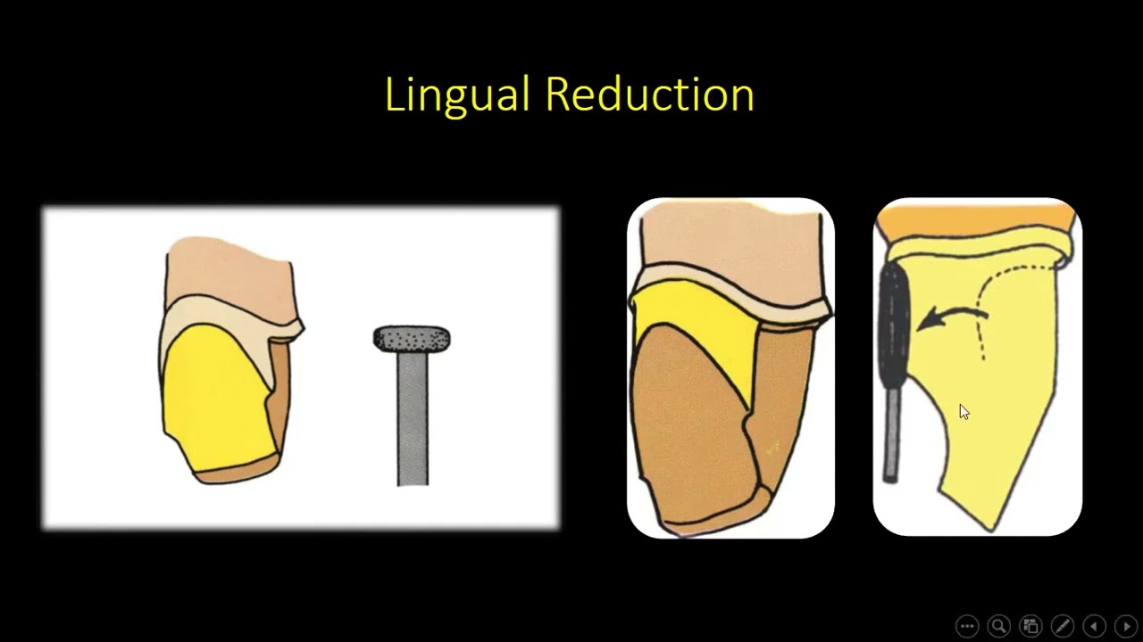 نقاط هامة في تحضير الأسنان للتركيبات الثابتة  الجزء الثاني : د طاهر خطاب