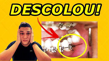 Como descolar o Bracket do aparelho?
