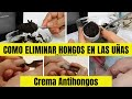 Crema Antihongos | Como Eliminar Hongos en las Uñas, en la Piel con Remedios Caseros