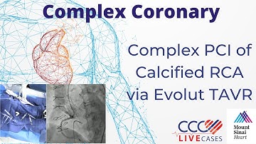 PCI of LM and LCx using Rotational Atherectomy - CCC Live Cases October 2017