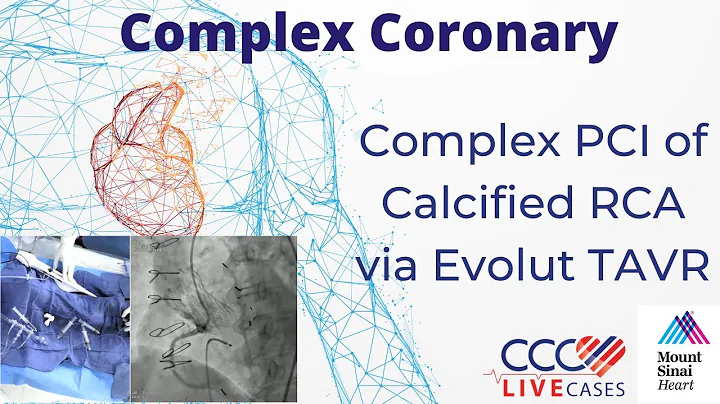 PCI of LM and LCx using Rotational Atherectomy - CCC Live Cases October 2017