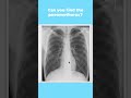 Can you find the pneumothorax? (Pt 2) #Shorts