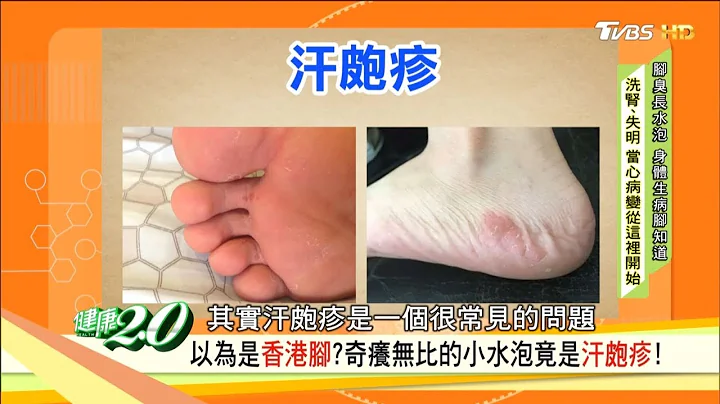 脚痒抓一抓就好？抓出伤口溃烂是糖尿病警讯！以为“香港脚”竟是汗疱疹！健康2.0 - 天天要闻