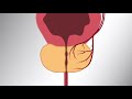 Prostatic Artery Embolization PAE Patient Video