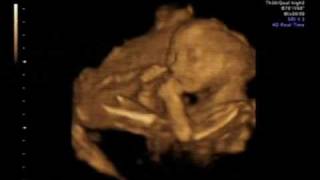 Ecografie 22 Saptamani Youtube