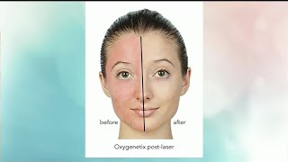 Aesthetic Everything:OXYGENETIX can help heal and camouflage damaged skin