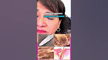 ¿Cuánto tiempo se tarda en eliminar los ácaros Demodex?