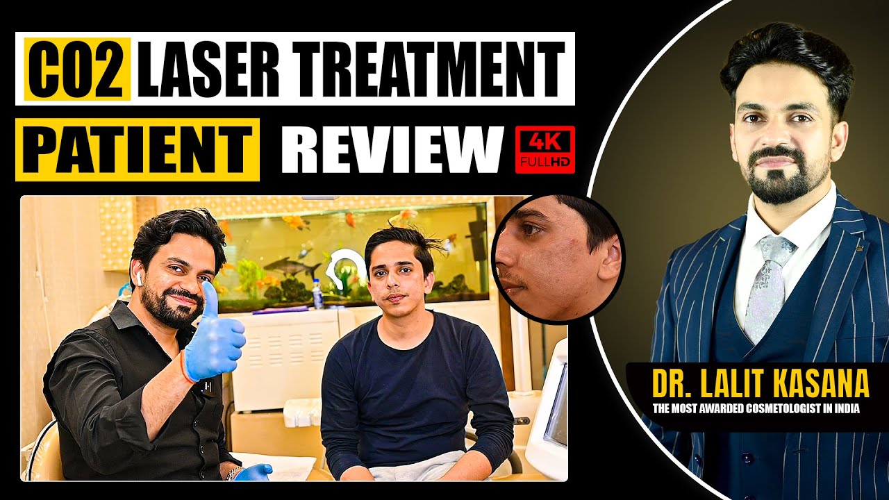 CO2 Laser Treatment Acne Scar Removal with CO2 Laser Treatment - Before & After Patient Review