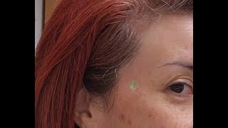 Taiyang Acupunctureacupressure Point