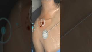 طريقة تركيب CENTRAL venous line part2