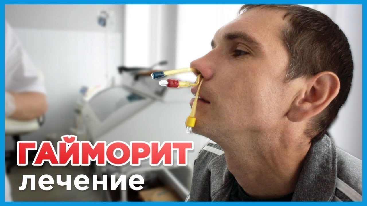 Лечение гайморита у взрослых. Введение антибиотика в пазухи носа во ...