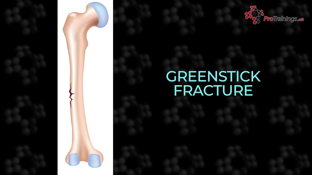 Greenstick Fracture