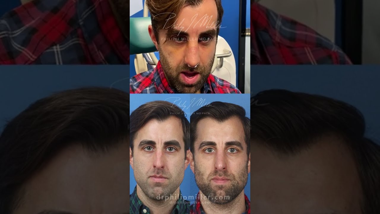 Cast Off Revealed! Incredible Rhinoplasty Results With A Very Happy Gentleman