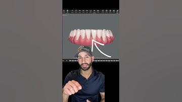 When we do IPR with Invisalign for overcrowding.