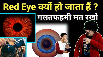 Red Eye 👁️ क्यों होता हैं  #shorts / Jasmin Patel / #jasstag