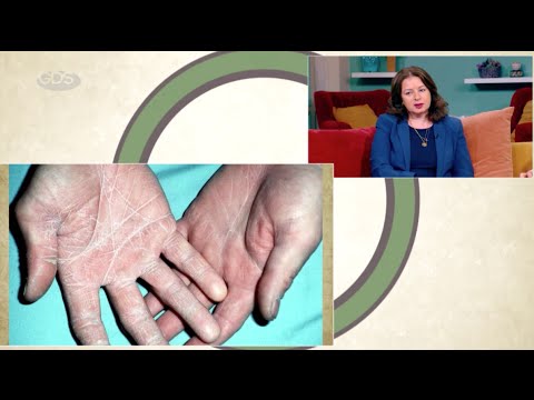 როგორ ავიდიროთ თავიდან სოკოვანი ინფექციები და როგორია მკურნალობის მეთოდები?