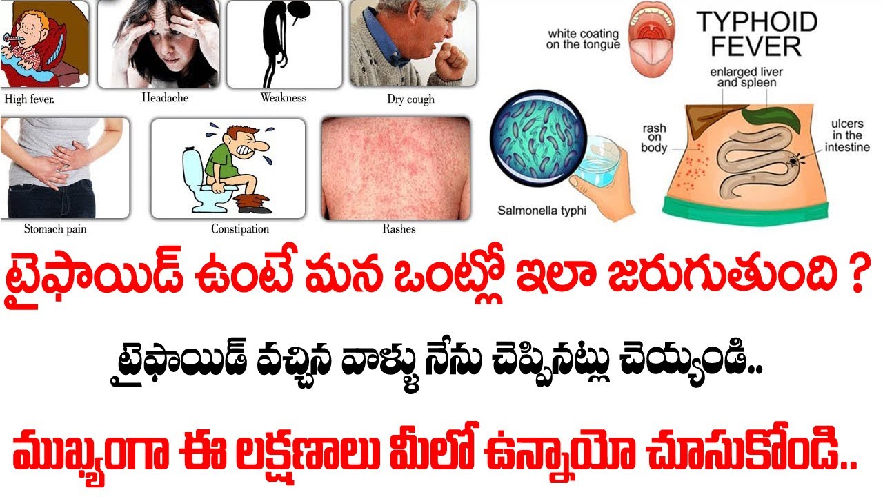 Typhoid Fever Symptoms , Cause, Treatment, Tests, Diet | Doctor Advice | DR. ANJALI
