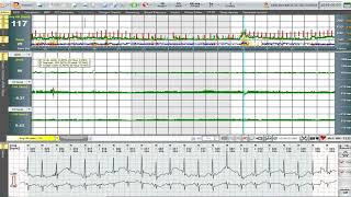Video 6 Evaluation of #ventricular and #supraventricular events