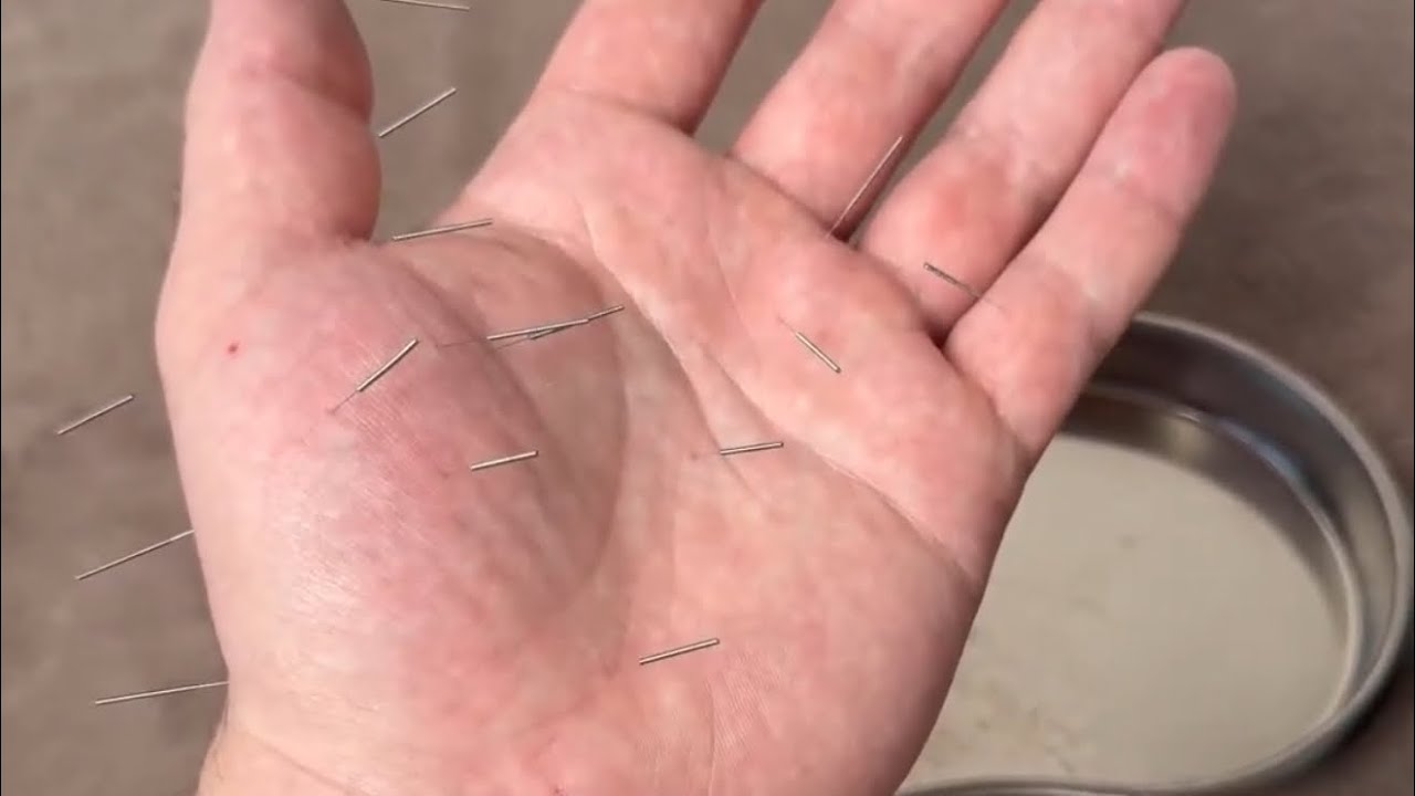 Иглоукалывание в ладонь 🖐️ Су Джок 